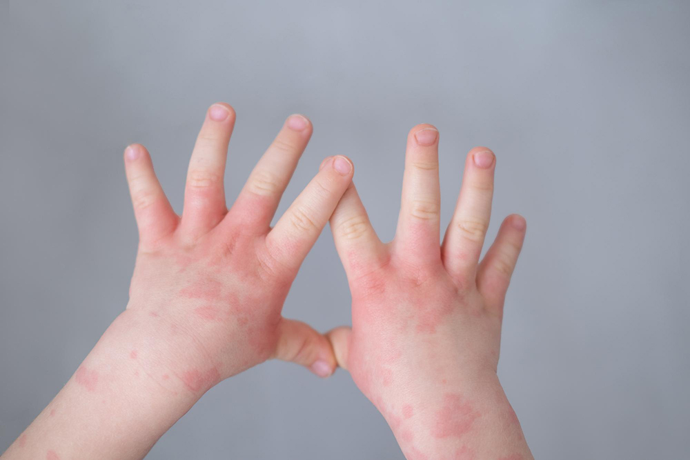 Infant and Toddler Eczema: The Gut Microbiome Connection